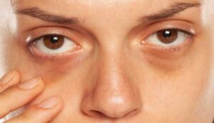 Yeux et troubles occulaires
